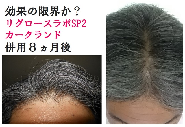 リグロースラボSP2・カークランド併用8ヵ月後