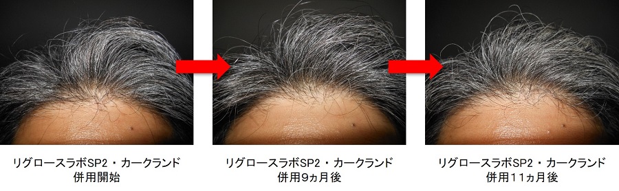 リグロースラボSP2・カークランド併用11ヵ月後の生え際